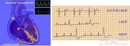 患持續性室性早搏究竟應如何根除和醫治