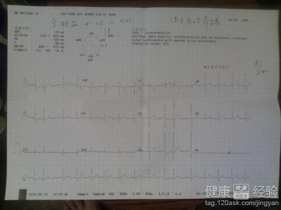 早搏是由於什麼引起的會遺傳嗎