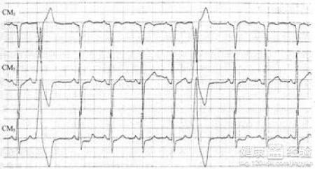 房性早搏請問該怎麼辦
