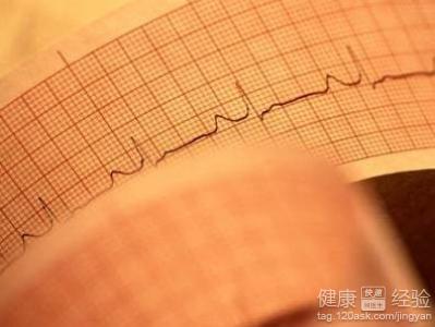 單純早搏是心髒病嗎