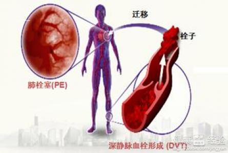 深靜脈血栓須多長時間能痊愈