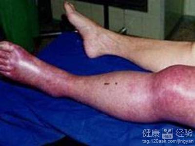 右下肢靜脈血栓以有4月了好治療嗎