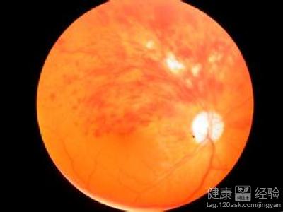 眼睛靜脈血栓如何治療好