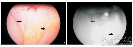 眼底靜脈血栓都用那些藥物可以治療