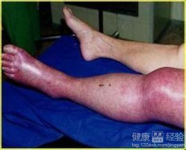 左下肢深靜脈血栓如何治療副作用少