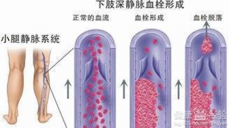 腿上靜脈血栓要忌口什麼