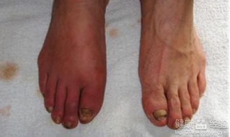 怎樣可以確診自己是深靜脈血栓病