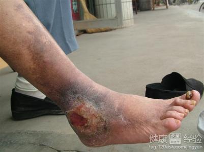 靜脈血栓的治療方法