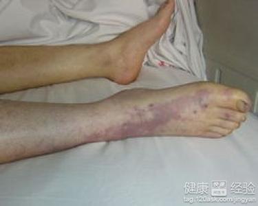 股骨頸骨折下肢靜脈血栓怎麼辦