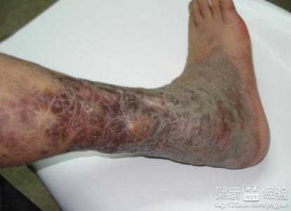 下肢靜脈血栓有哪些症狀