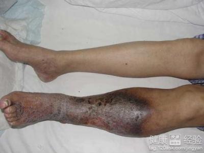 下肢靜脈血栓有什麼好的治療方法