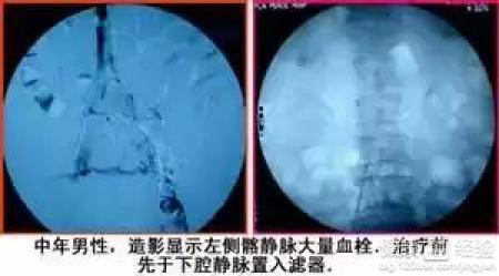 下肢靜脈血栓會導致小腿部腫脹嗎