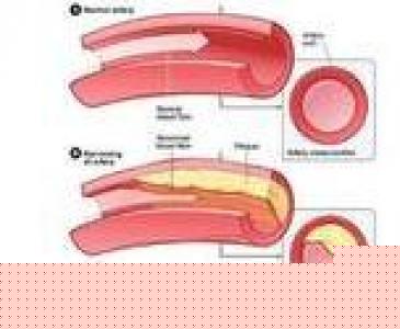 手術後引起靜脈血栓怎麼辦