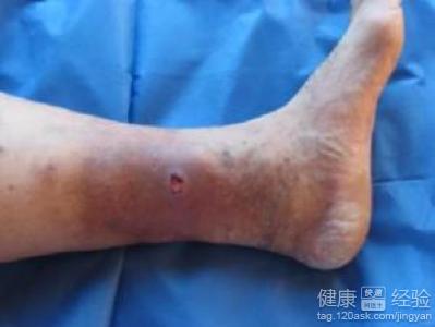 斜疝手術後會得靜脈血栓嗎