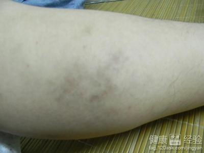 腿部靜脈血栓怎麼治