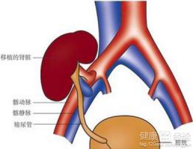 深靜脈血栓治療不徹底有後遺症嗎