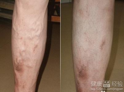 都有哪些原因導致靜脈血栓？