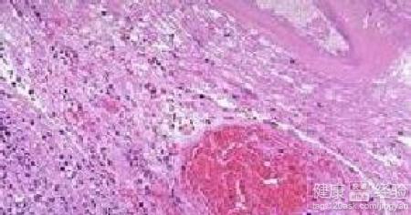 靜脈血栓形成在飲食上要注意什麼