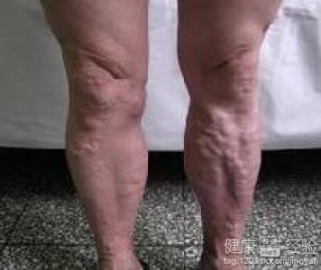 靜脈血栓形成怎樣進行食療