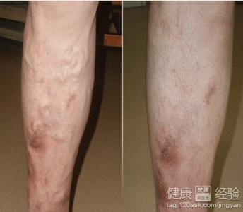 靜脈曲張好治嗎？