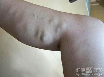 靜脈曲張要怎麼治療才好？