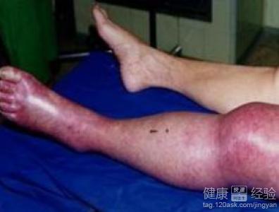 怎麼科學治療靜脈血栓疾病患者？