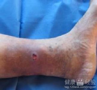 如何治療下肢動脈硬化閉塞