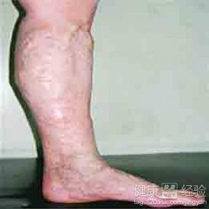 下肢動脈硬化是什麼意思