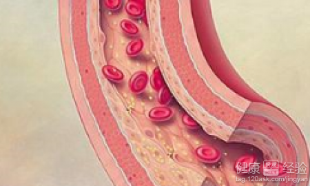 動脈硬化該怎麼治療