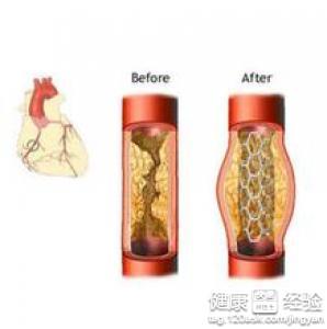 中醫如何防治動脈粥樣硬化