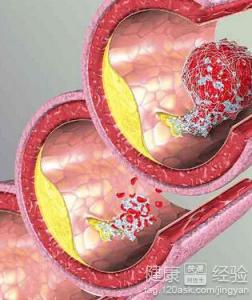 頸動脈硬化是怎麼引起的