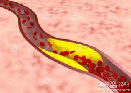 動脈粥樣硬化怎麼治