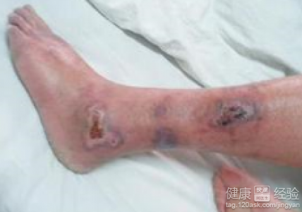 治療動脈硬化閉塞症