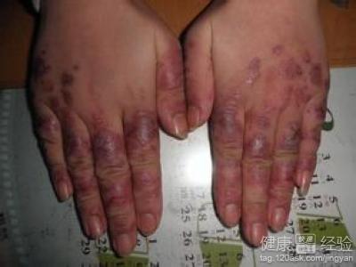 腦動脈硬化發冷渾身