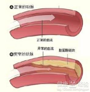 腦動脈硬化確診做什麼檢查