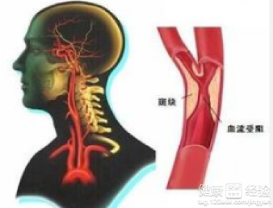 什麼叫主動脈硬化