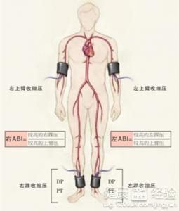 動脈硬化閉塞症治療費用