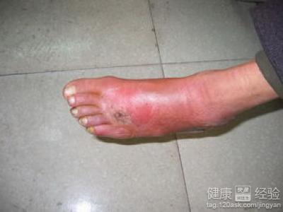 中醫治動脈硬化