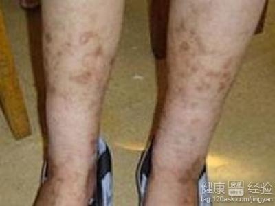 雙下肢動脈硬化治療