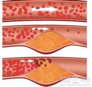 導致動脈硬化的原因有哪些