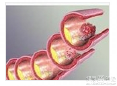 頸動脈粥樣硬化斑塊怎麼辦