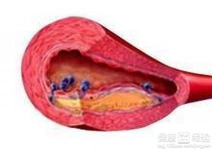 動脈硬化發病原因