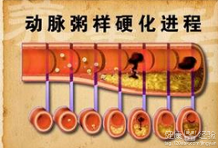 動脈硬化啥症狀