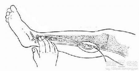 脾動脈栓塞術後發燒怎麼辦