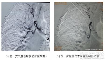 支氣管動脈栓塞術術後仍咯血怎麼辦