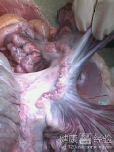 腸系膜上動脈栓塞中藥能治好嗎