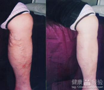 脈管炎患者日常要注重哪些保健