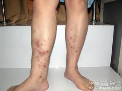 血液栓塞應該選用什麼溶栓藥治療？