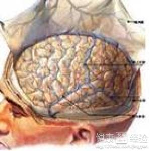 治療腦梗塞的有哪些方法！