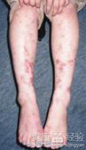 患了動脈炎該怎麼辦？